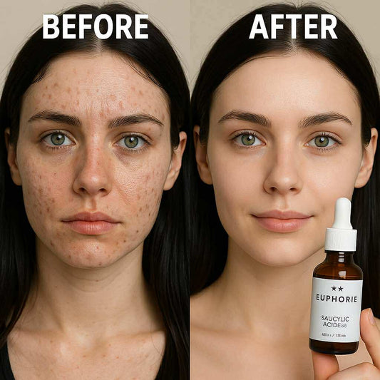 وداعاً للبثور والرؤوس السوداء – الحل الفعّال بحمض الساليسيليك